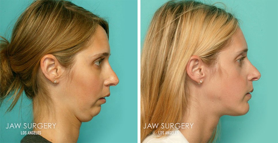 Enhancing Your Profile: Jaw Surgery Before And After